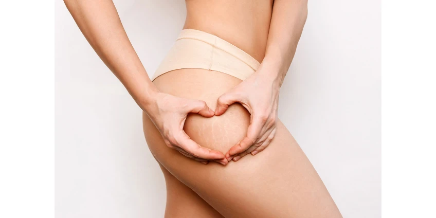 Top-Behandlungen gegen Cellulite: Was wirklich funktioniert