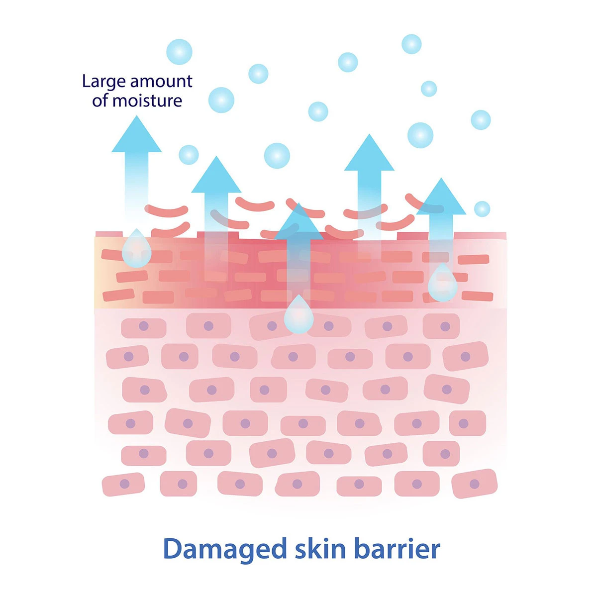 was ist eine gestörte Hautbarriere und warum ist das ein Problem