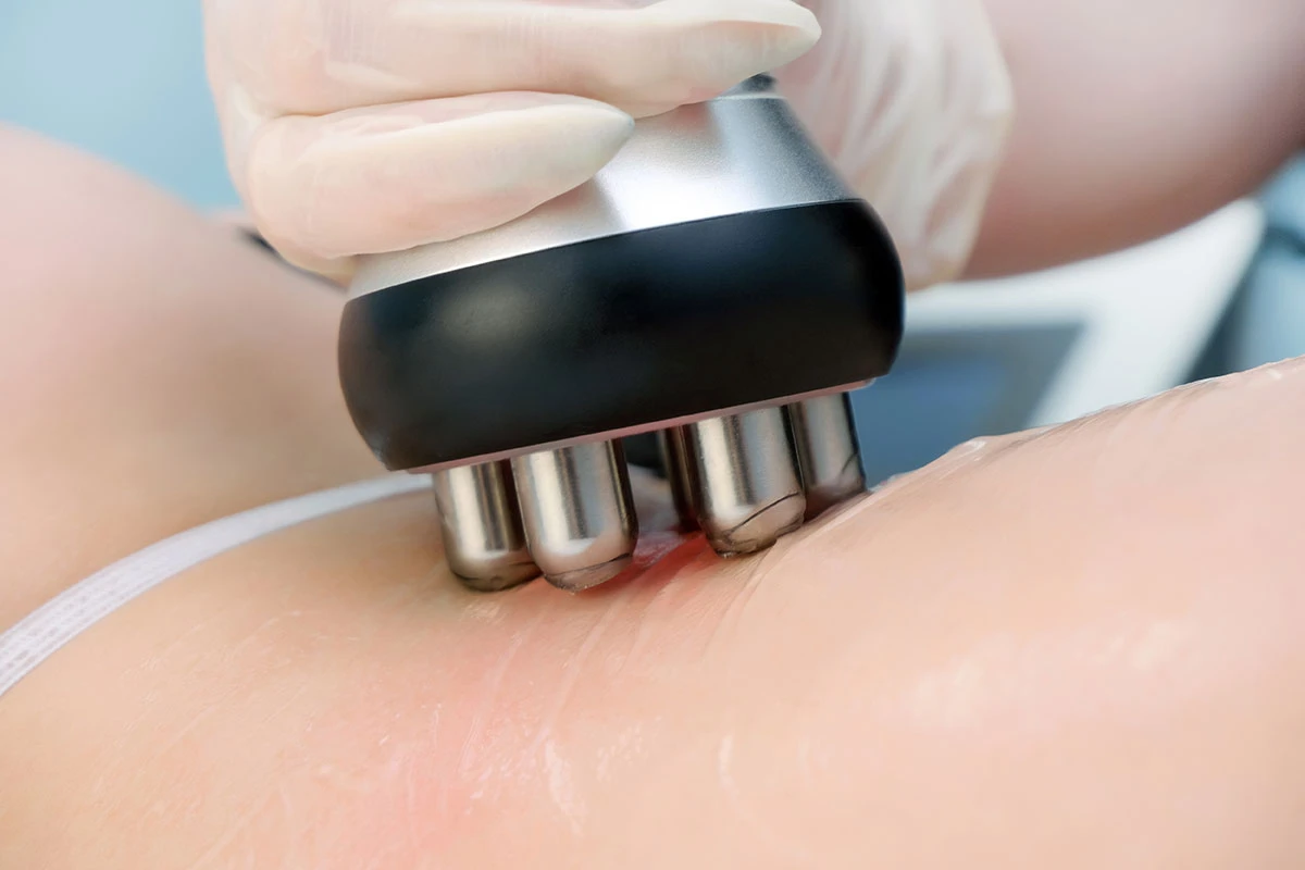 wie man Kunden das RF-Lifting-Verfahren effektiv vorstellt