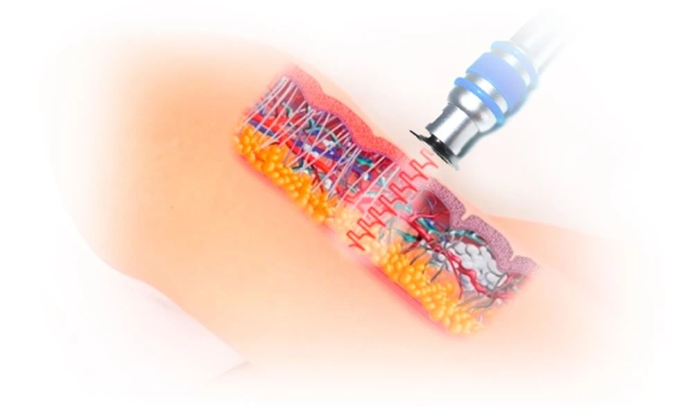 Wie wird die Stoßwellentherapie durchgeführt