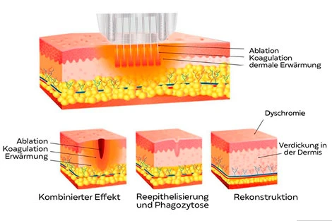 Radiofrequenz Microneedling Gerät 9